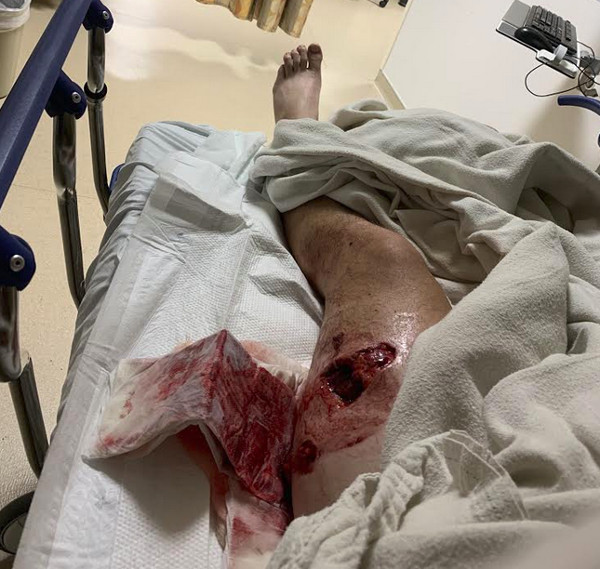 Severe leg wound from grizzly bear attack.