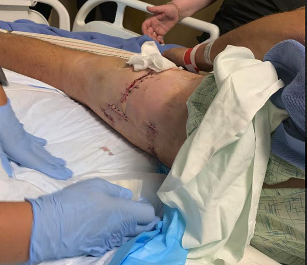 Victim's sutured leg after grizzly bear attack